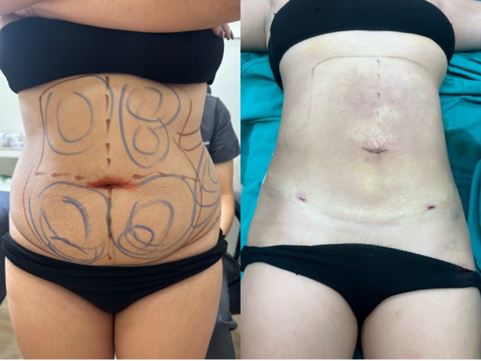 Lipo B/A 2